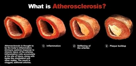 atherosclerosis pictures images.